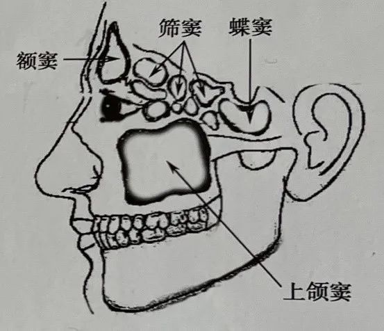 这是源于涎腺组织的肿瘤,最多见的原发部位为上颌窦,其次为鼻腔