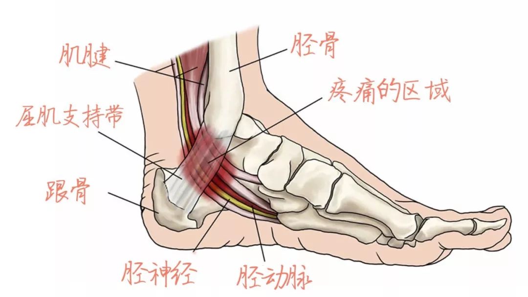 不是所有的脚底痛都是足底筋膜炎