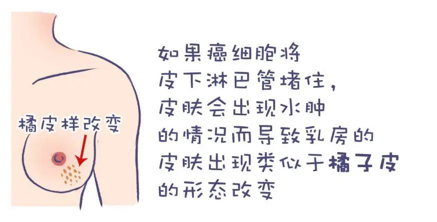 乳房反复湿疹竟确诊乳腺癌胸兆其实很明显