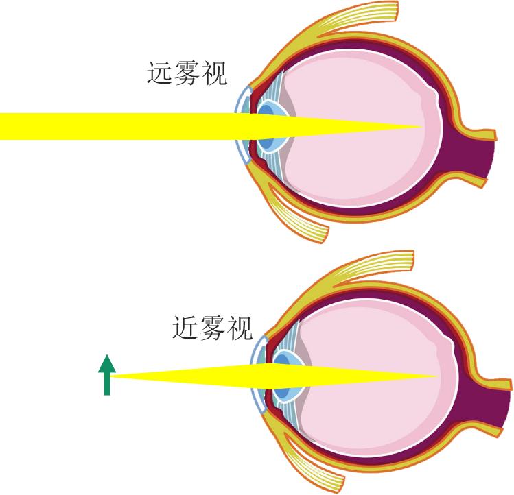 雾视治疗的分类03②周边离焦镜可以实现周边较大的