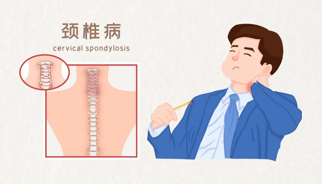 针对公众关心的颈椎病预防,治疗等问题问题进行了权威解答,健康中国带