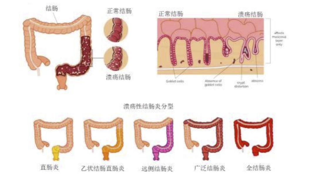 结直肠炎 澎拜新闻