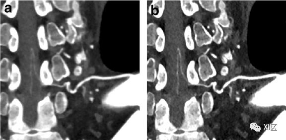 平滑算法与锐利算法对于adamkiewicz动脉的显示效果病例来源:日本全国