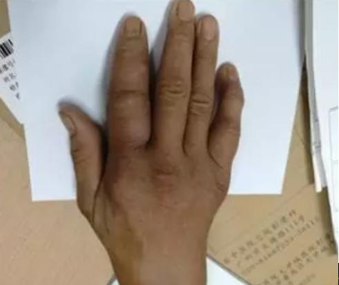 67五大常见风湿病的经典体征有哪些