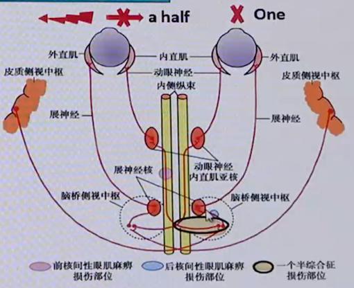 周围性眼肌麻痹核性眼肌麻痹一文掌握6种眼肌麻痹