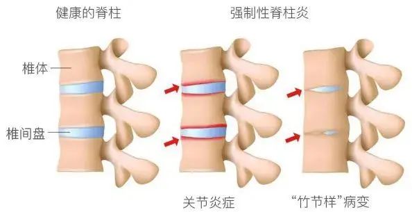 李宇春确诊强直性脊柱炎腰痛曾让她痛苦不堪