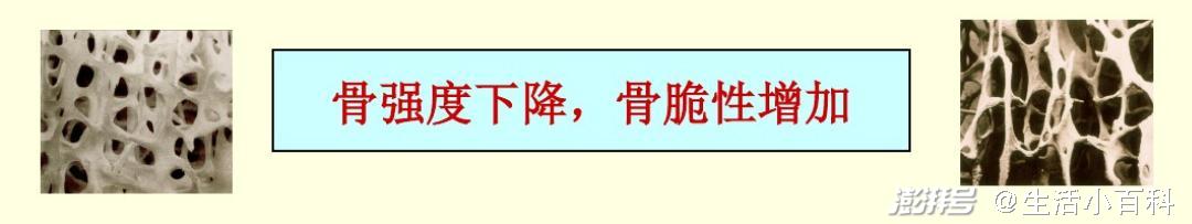 不明原因疼痛你了解骨质疏松症吗 澎湃号湃客 澎湃新闻 The Paper