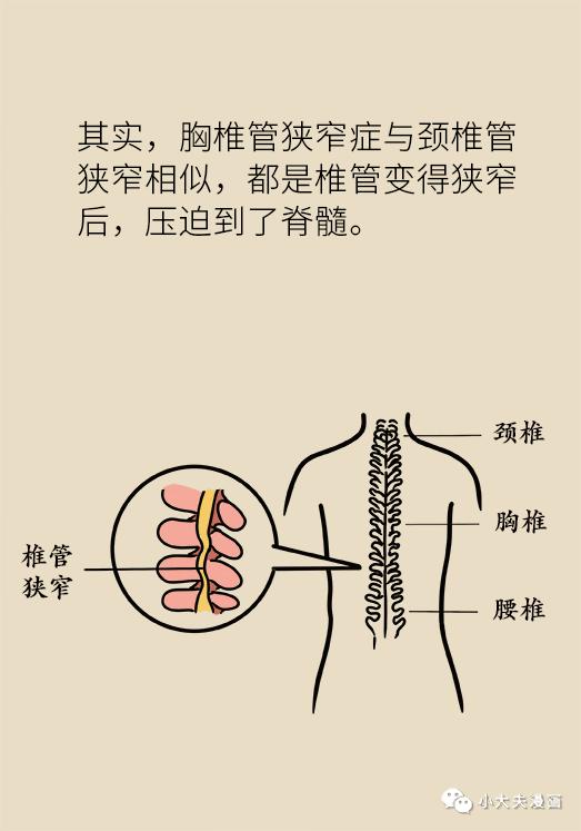 老寒腿,走路难?这种高致残疾病叫胸椎管狭窄