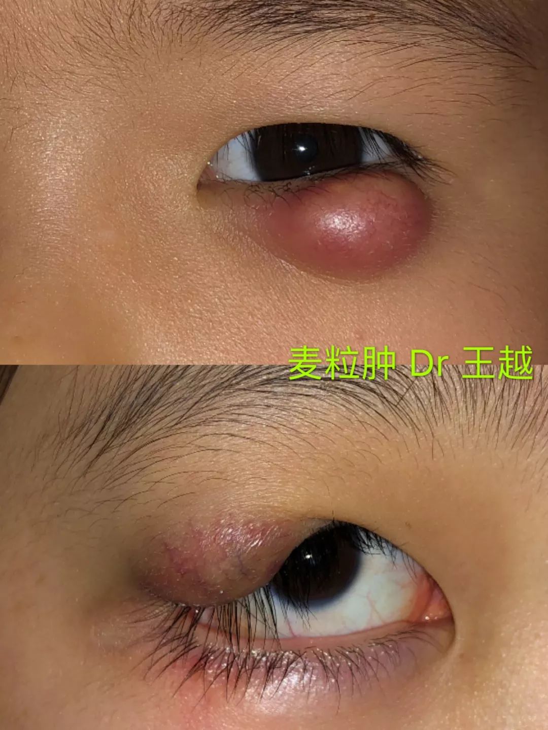 纹眼线后容易长针眼霰粒肿如何治疗