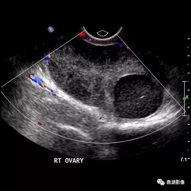 急诊卵巢扭转和阑尾炎如何区别,有哪些影像表现?