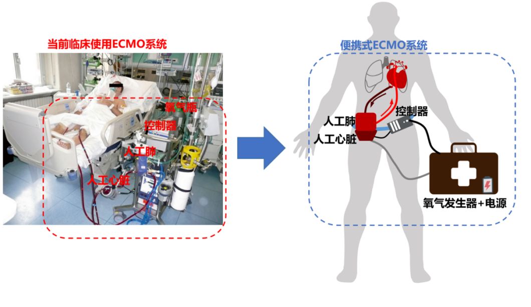 正在研发的便携式人工肺示(右图)与目前临床人工心肺(左图)对比示意图