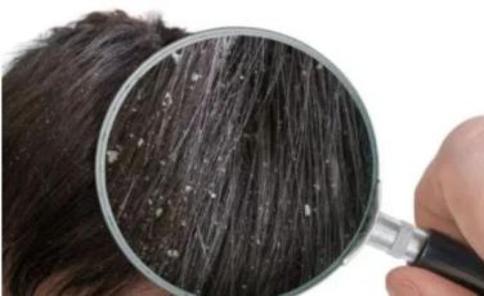 为什么油脂分泌越旺盛的头皮,头皮屑就越多?