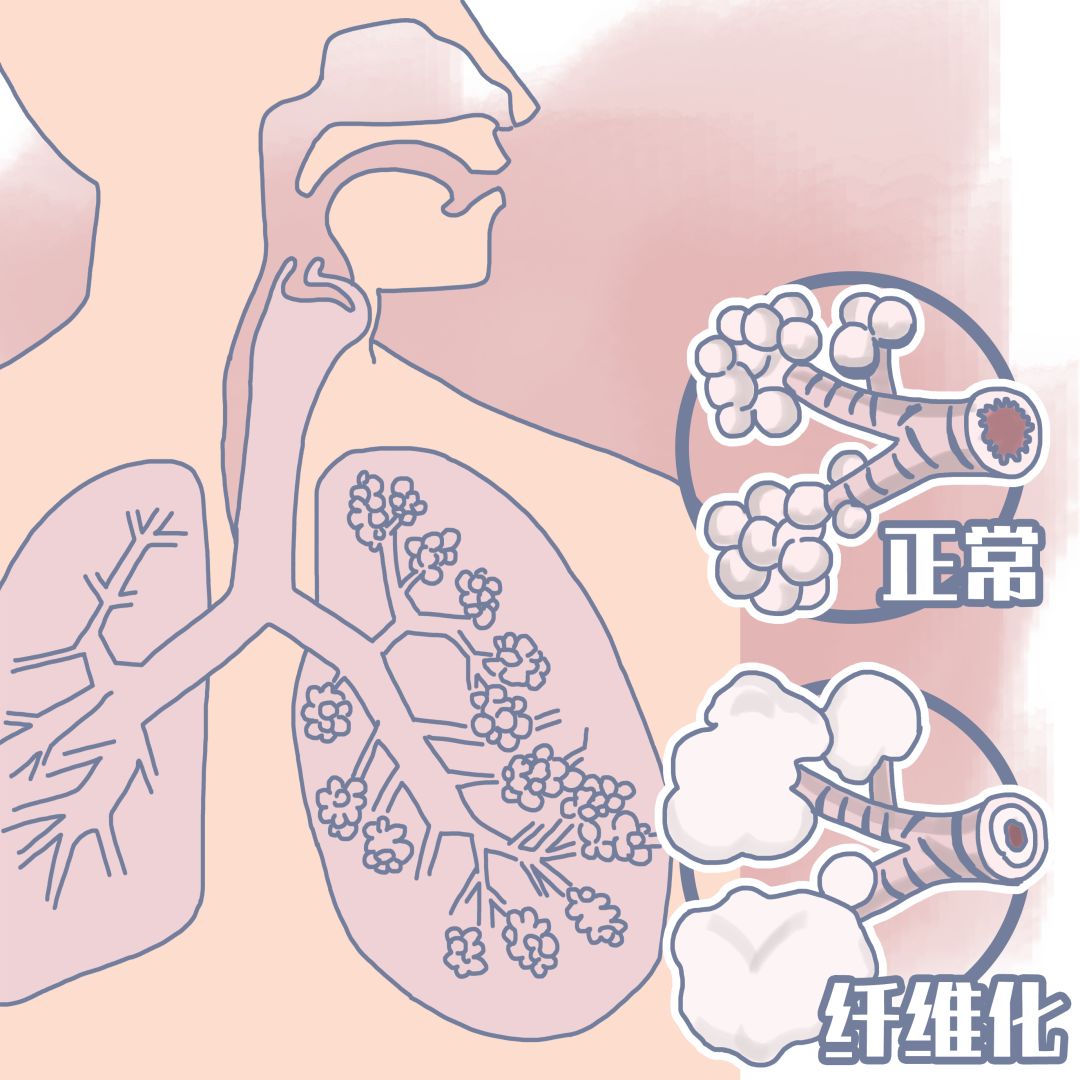 如果发生肺纤维化,肺部就会变硬,肺泡的通气功能,气体交换的效率都会