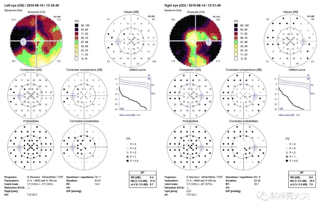 octopus视野检查示右眼周边视野缺损;左眼环形暗点累及中心