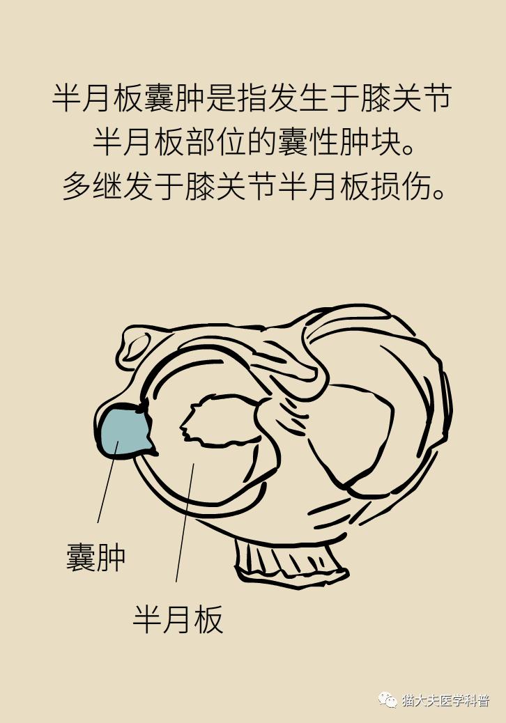 半月板也会长囊肿?会不会致残?