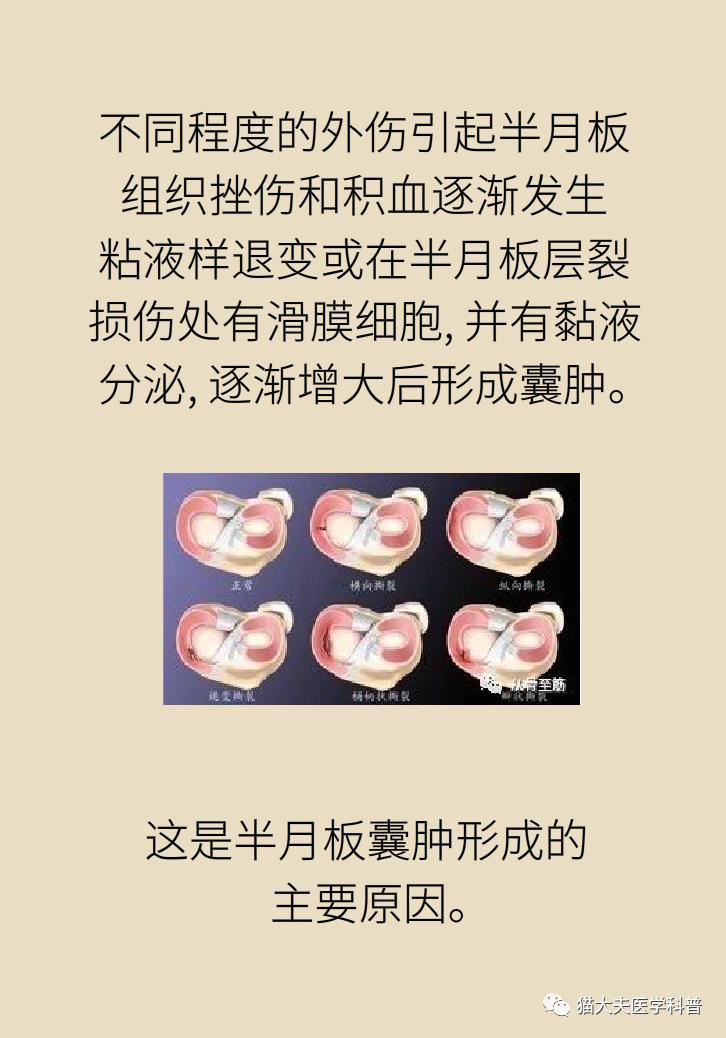 半月板也会长囊肿?会不会致残?
