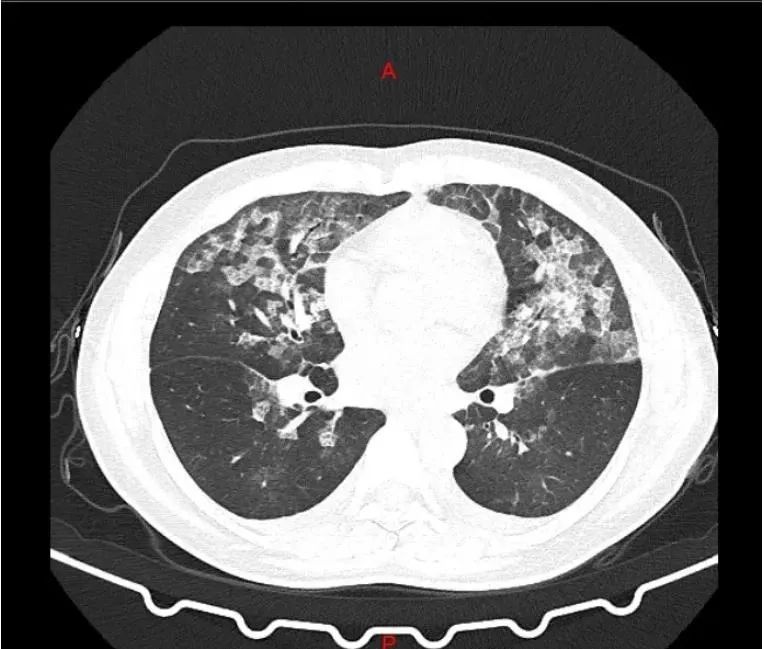 两位女士肺部ct呈毛玻璃影,原因是每天在做的这件事