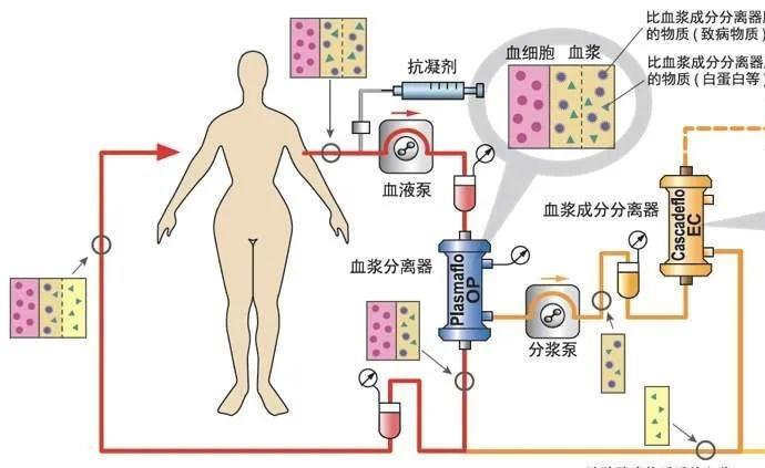 世界脑膜炎日,战胜脑膜炎的三驾马车之一:血浆置换/免疫吸附治疗