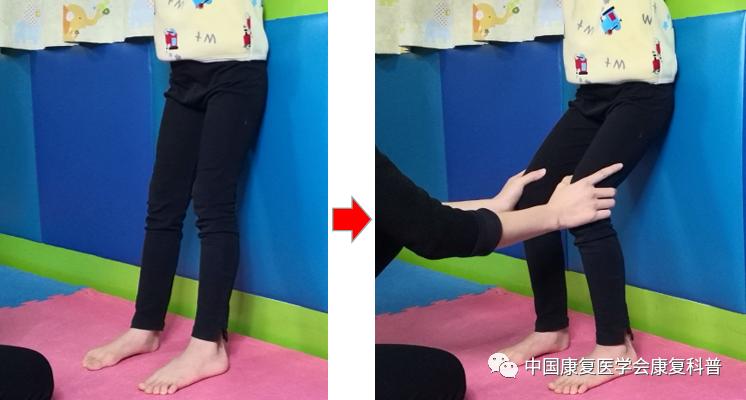 脑瘫儿童如何康复?膝过伸运动治疗学起来