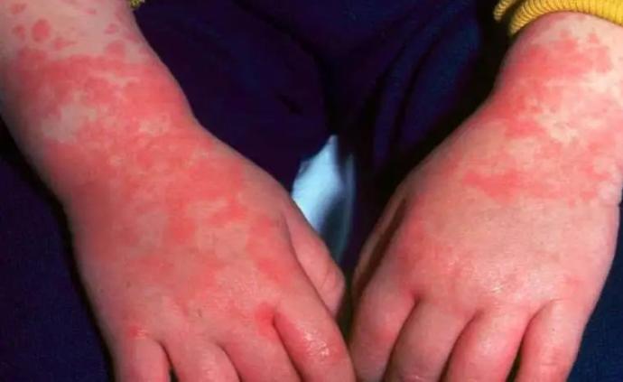 幼儿急疹,麻疹,川崎病,水痘,风疹,如何识别不同皮疹?