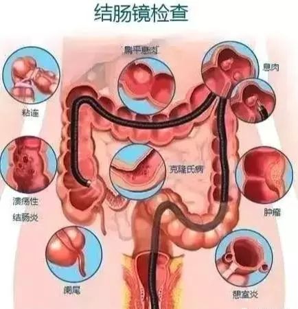又有一年轻男子把肠癌当痔疮究竟该如何分辨?