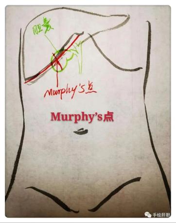 我们叫它murphy"s点(事实上,胆囊的位置也会随着肝脏的大小软硬而变化