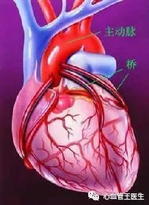 最新研究,有心肌桥的人比没有心肌桥的人,发生心梗风险高3倍