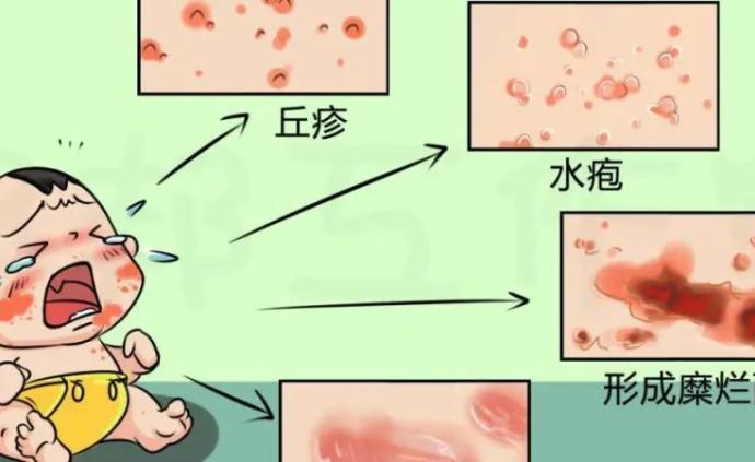 "纯植物"湿疹药膏更安全?错,80%含激素
