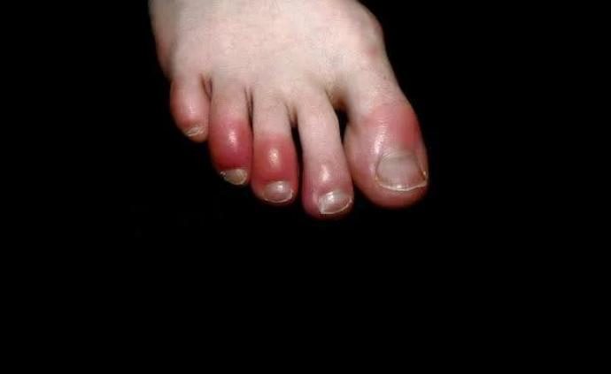 脚趾"冻疮",缺氧不难受……新冠感染还有哪些怪症状?