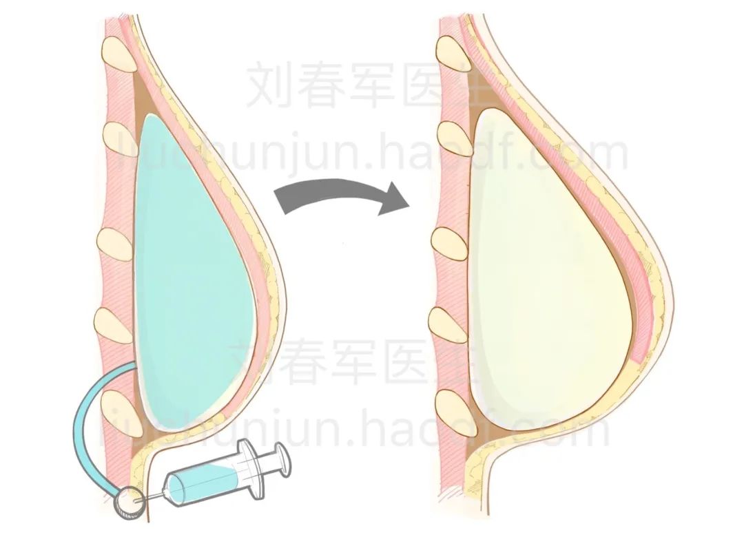 而不是组织扩张器,这需要询问乳房再造的医生