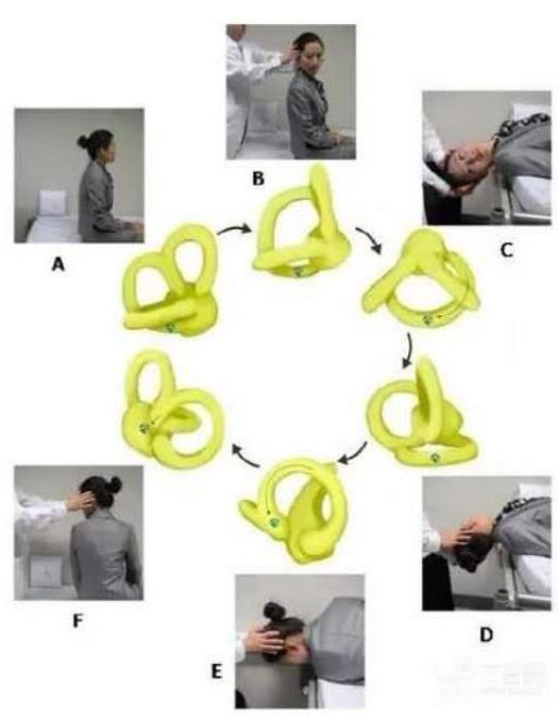 包教包会良性阵发性位置性眩晕手法复位速来学67