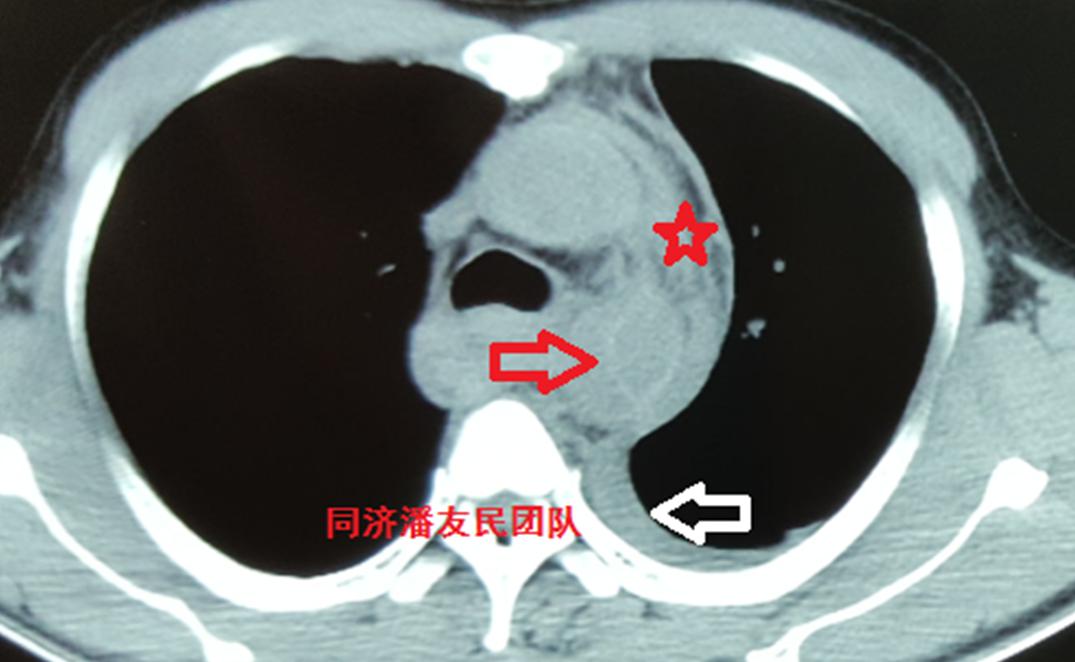 基层医院平扫ct提示胸降主动脉起始部内膜片影(图1,疑诊主动脉夹层