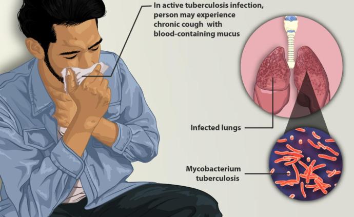 肺结核