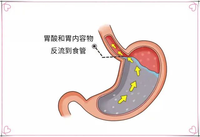 新冠肺炎期间胃食管反流病的防治