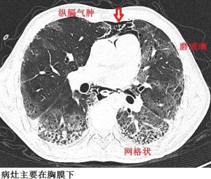 极易漏诊的间质性肺炎,从ct上怎么看?