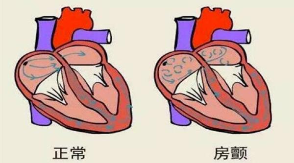 67房颤患者会出现心慌,胸闷,乏力等症状,甚至出现脑梗塞,心衰等并发