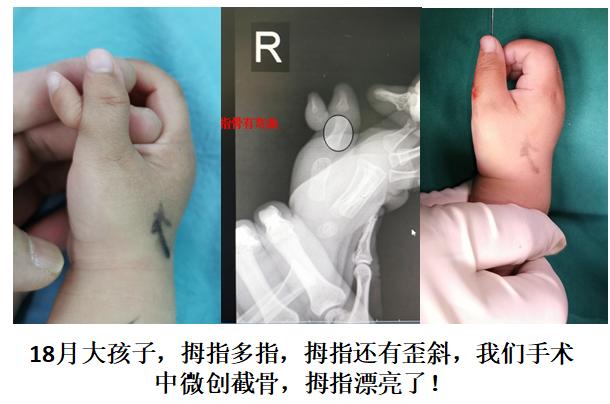孩子出生后发现多长了一个手指,要不要做切除手术?