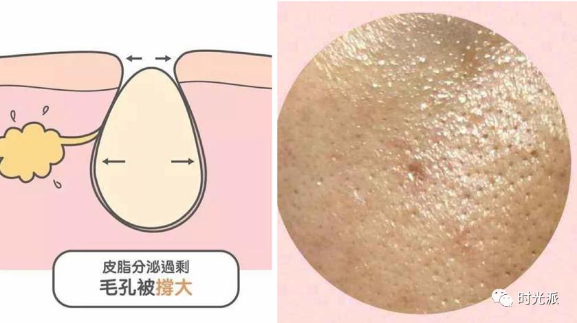 皮脂腺过度分泌引起的毛孔粗大