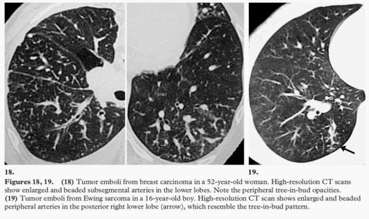 单独依靠ct诊断困难,左下肺实变影提示不能放弃查肿瘤