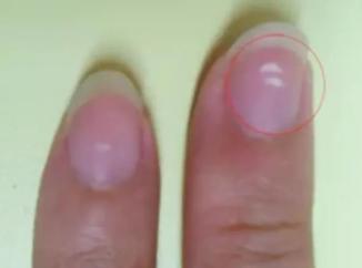 除了灰指甲,"指甲异常"还可能是什么病?