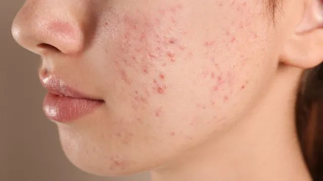根据不同的症状表现,痤疮大体可以分为粉刺型,丘疹脓疱型和结节囊肿