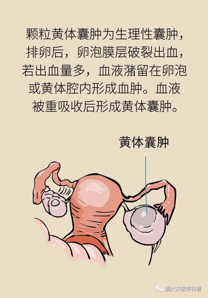 卵巢囊肿是肿瘤吗?需不需要治疗?