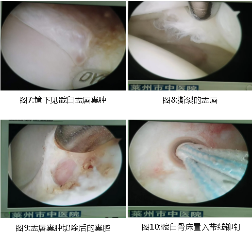 治疗方法:关节镜检查清理,髋臼盂唇缝合修复术.