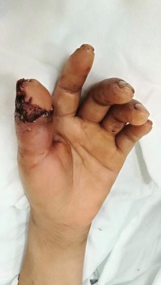 【浦人医·技术】大拇指保住了:"移花接木"脚趾变手指