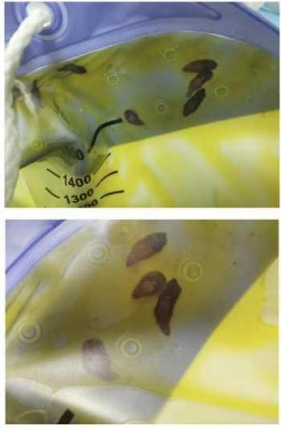 西瓜子吗不这是老伯胆汁里的虫子慎入
