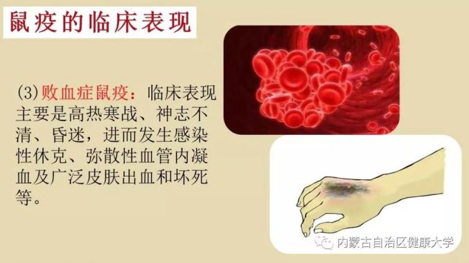 鼠疫的症状 澎拜新闻