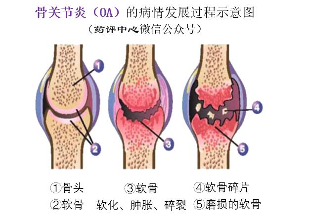 硫酸氨基葡萄钾片_盐酸氨基萄糖胶囊价格_盐酸氨基葡萄糖片