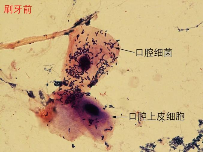 据推测,正常健康人的口腔中有1000亿个细菌,唾液中的细菌细胞快则20