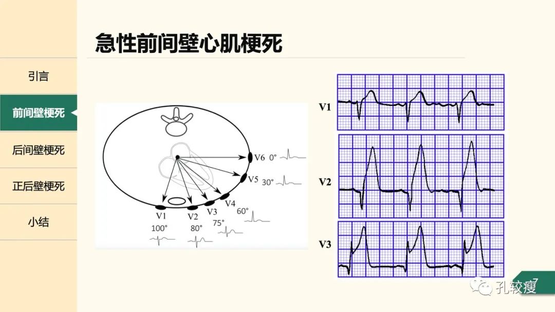 心肌梗死心电图定位的困惑及思考