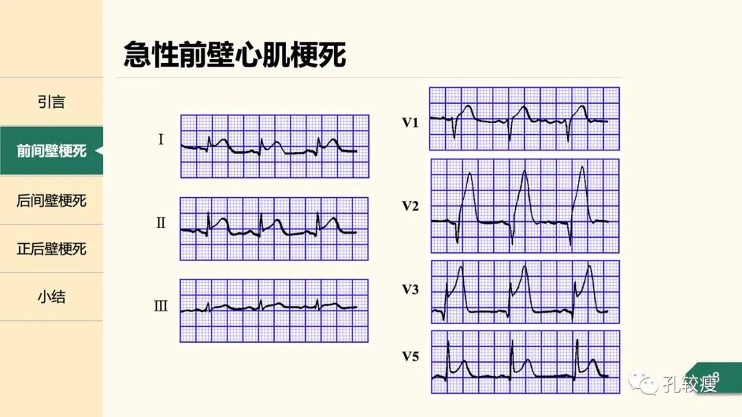 心肌梗死心电图定位的困惑及思考